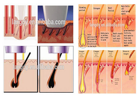 2000w 950nm آلة إزالة الشعر IPL الدائم
