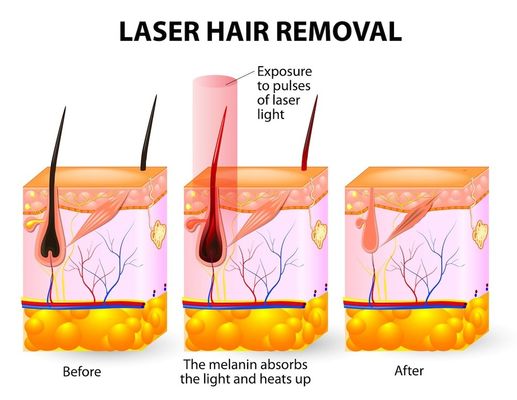 صالون سبا 20HZ 808 جهاز إزالة الشعر بالليزر ديود