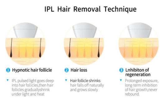 2000 واط OPT IPL + 808NM تقنية DIODE LASER لمعدات إزالة الشعر