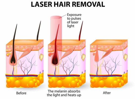 OPT IPL / OPT آلة متعددة الوظائف المحمولة لإزالة الشعر بسرعة IPL