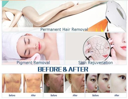 OPT IPL / OPT آلة متعددة الوظائف المحمولة لإزالة الشعر بسرعة IPL